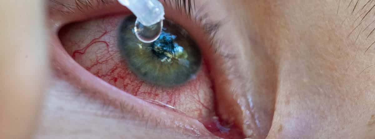 Erosión corneal: gota de colirio en el ojo humano