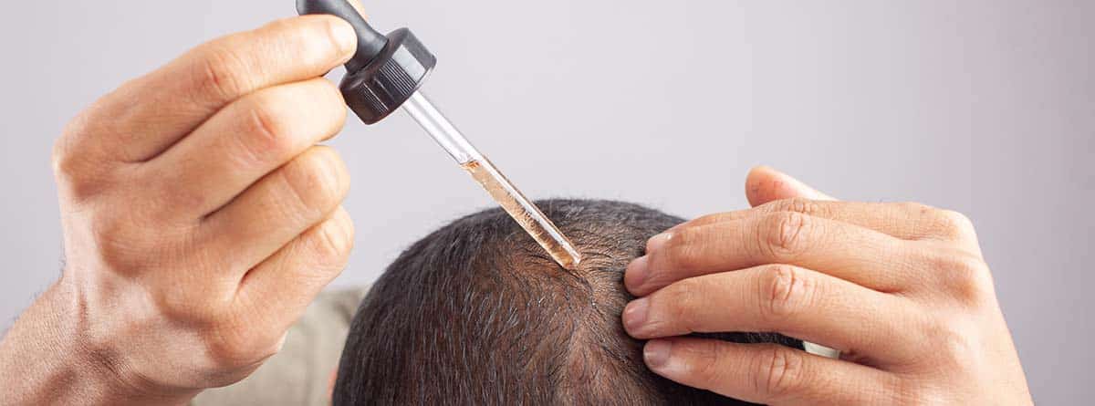 Minoxidil :aceite de minoxidil, joven echando gotas de minoxidil en cuero cabelludo