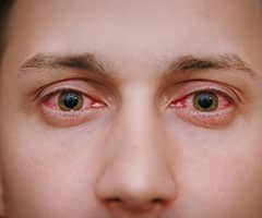 Ojo rojo y doloroso: rostro de hombre joven con los ojos enrojecidos