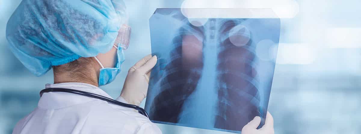 Bronquiectasias: especialista estudiante una radiofrafía de pulmón