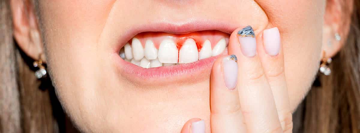 Gingivitis: boca de mujer con sangrado en las encias