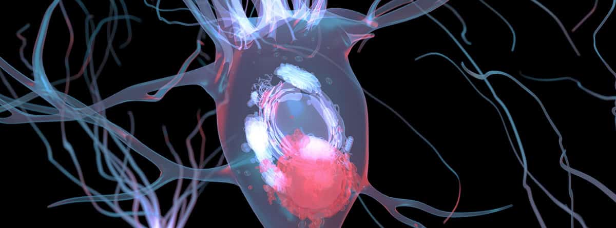 Demencia de cuerpos de Lewy:Cuerpo de Lewy en una neurona afectada por la enfermedad de Parkinson