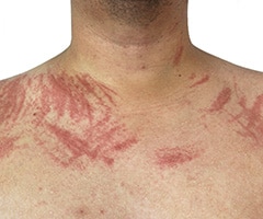 ¿Cómo tratar el dermografismo?: torso de hombre con rayas en la piel