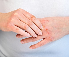 Eccemas y tipos: manos de mujer con lesiones en la piel