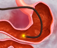 ¿En qué consiste una endoscopia digestiva?: Endoscopia estomacal. Balón gástrico dentro de un estómago.