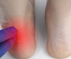 Tendinosis: talón rojo