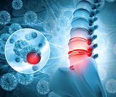 Tumores óseos malignos: Cáncer de columna o enfermedad de tumor espinal