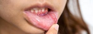 Enfermedad de Behcet: mujer con llagas en la boca