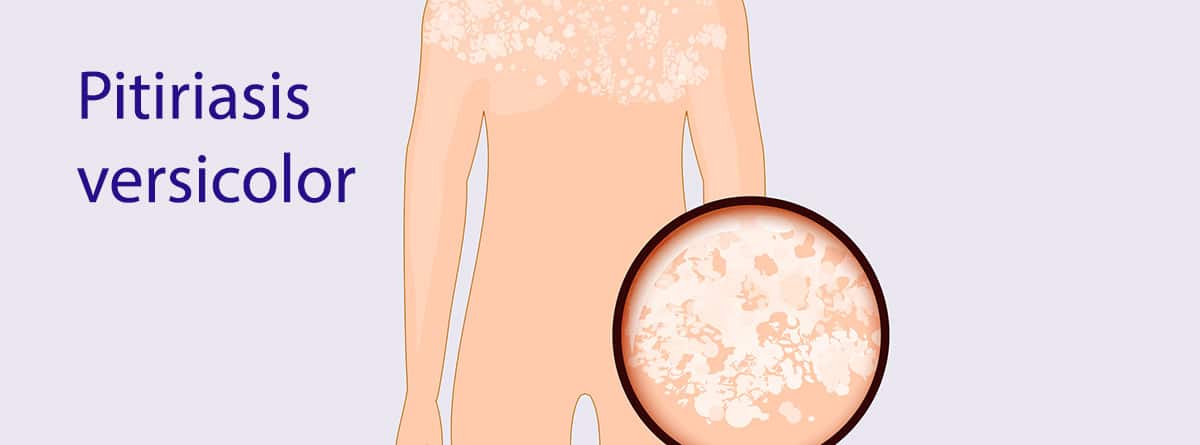 Pitiriasis versicolor: dibujo de cuerpo humano con pitiriasis versicolor y una lupa ampliando el problema de la piel