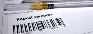 ¿Qué es el sarcoma de Kaposi?: Solicitud de biopsia para detectar sarcoma de Kaposi