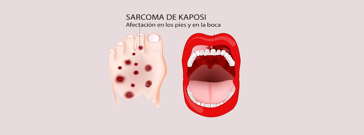 Dibujo de El sarcoma de Kaposi afecta la boca y el pie. El síntoma del sarcoma de Kaposi son lesiones cutáneas rojas o moradas que parecen hematomas.