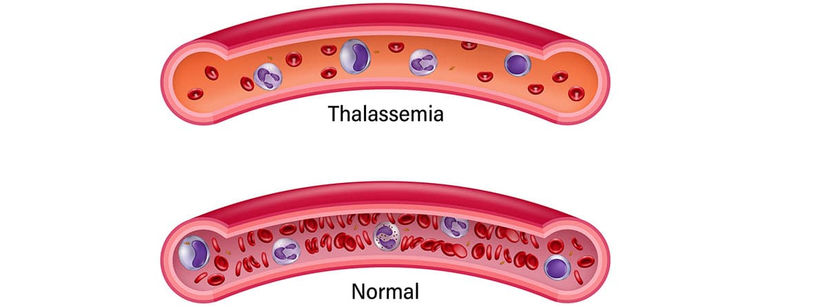 Talasemia: diferencia entre la sangre normal y la enfermedad talasémica