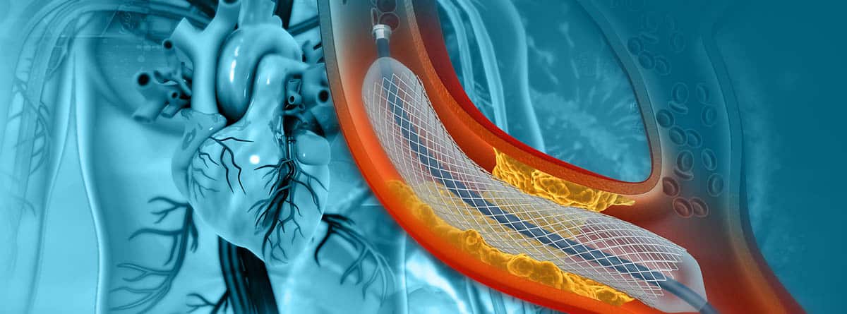 Angioplastia con balón: ilustración de angioplastia