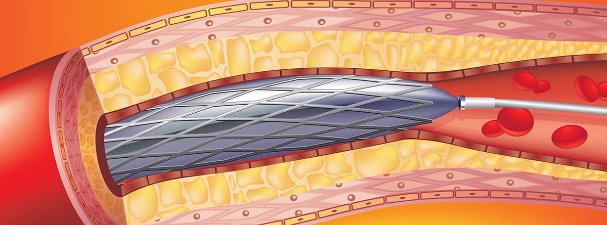 Angioplastia y stents