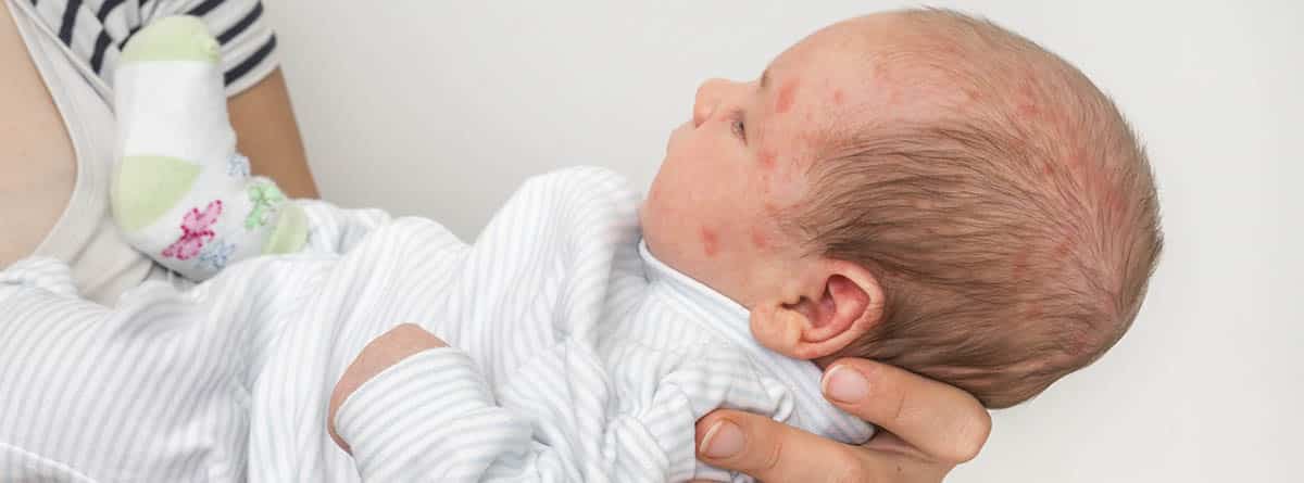 Vesículas de succión1: recién nacido en brazos de su madre con ampollas en la cara