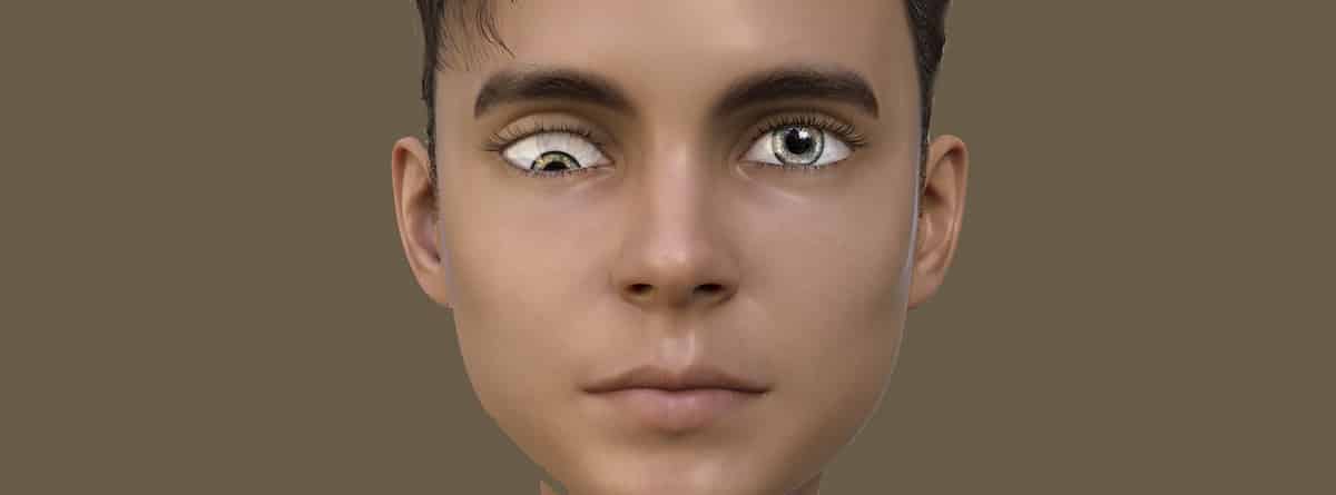 Anisometropía: imagen de chcio con los ojos asimétricos