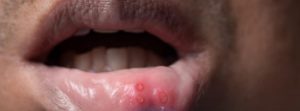 ¿Qué es la estomatitis?: boca de hombre con aftas en el interior de los labios