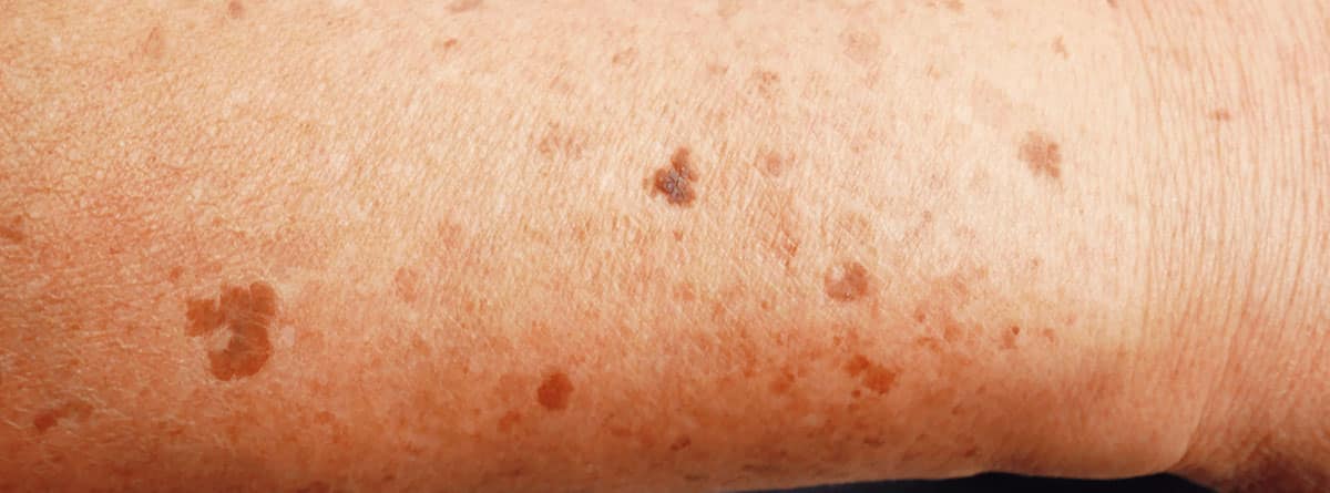 Manchas en la piel por la edad: brazo con manchas marrones en la piel