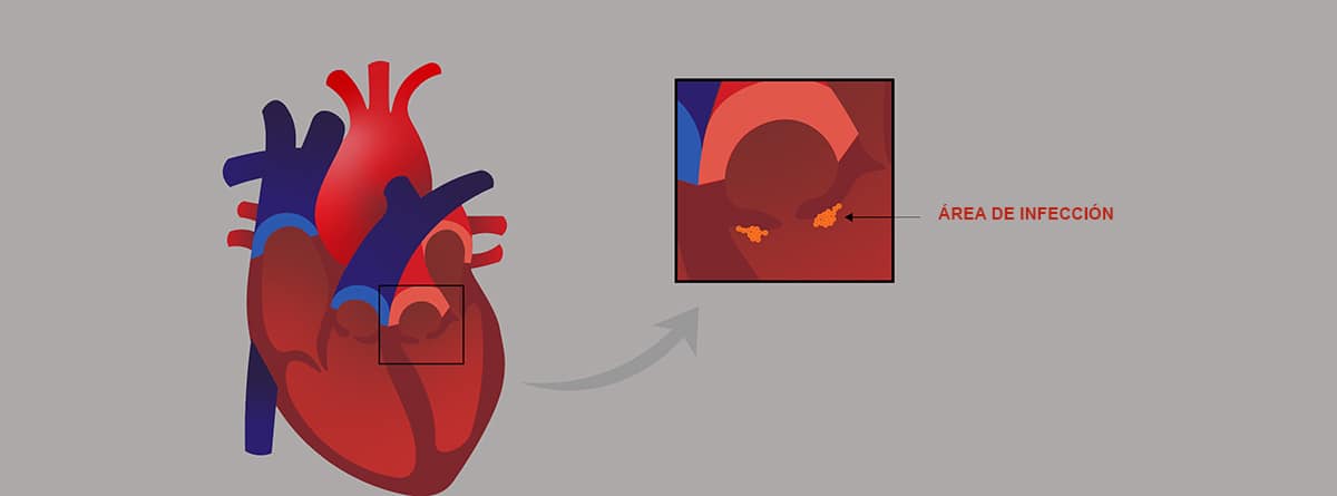 Endocarditis, dibujo de una endocarditis infecciosa