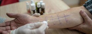 Prick test :Prueba cutánea de alergia en el brazo de un paciente