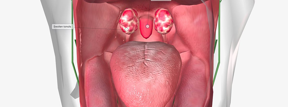 Tonsilolitos:es una afección común causada por una infección bacteriana de la boca y la parte posterior de la cavidad oral. 