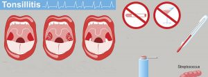 Bolas blancas en la garganta: caseum o tonsilolitos, infografía de amigdalitis. Signos, síntomas y Tratamiento.