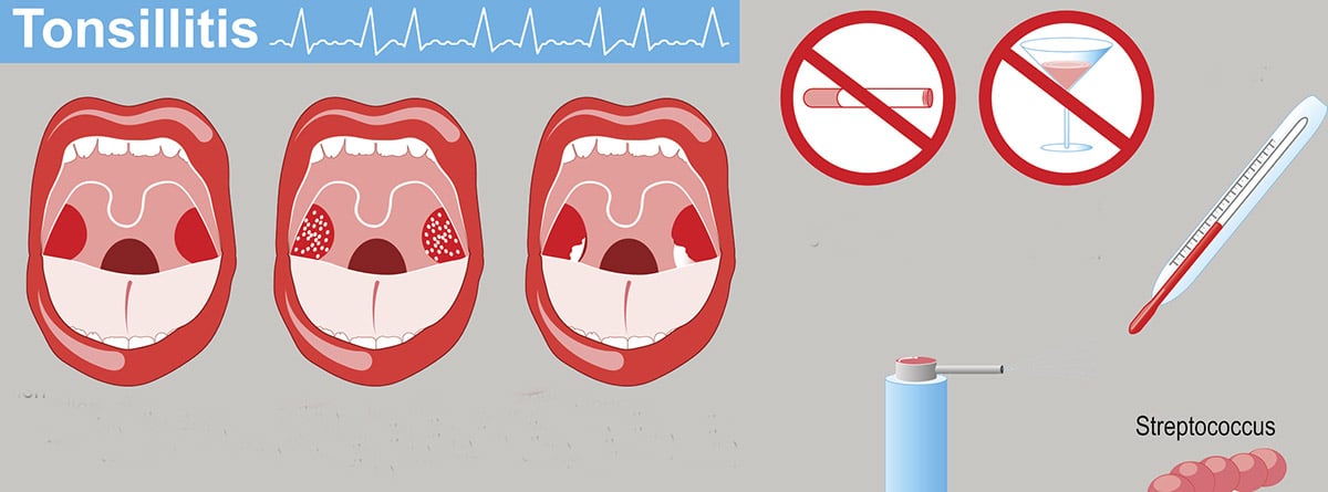 Bolas blancas en la garganta: caseum o tonsilolitos, infografía de amigdalitis. Signos, síntomas y Tratamiento.