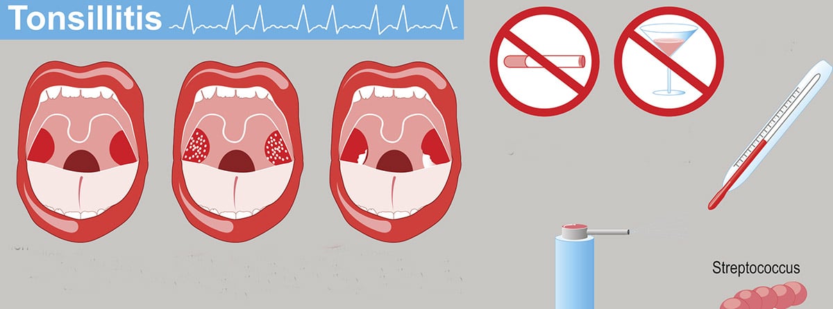 Bolas blancas en garganta: caseum o tonsilolitos -canalSALUD