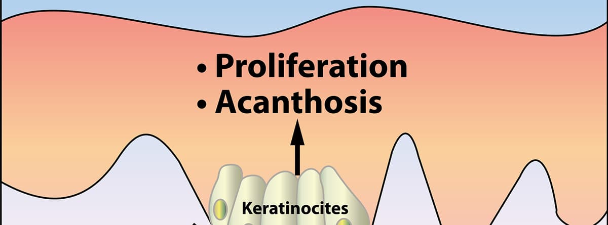 Acantosis nigricans: esquema de la proliferación de la acantosis nigricans