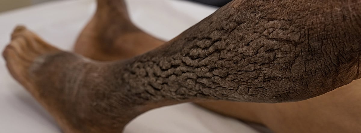 Acantosis nigricans: síntomas y tratamiento, Mujer mayor con Acantosis Nigricans en la pierna.