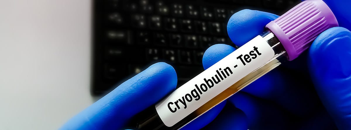 Crioglobulinemia: cómo se diagnostica y cura. Manos con guantes azules con un tubo de muestra de sangre