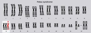 Síndrome de Patau: todo lo que debes saber . Cariotipo humano del síndrome de Patau. Anomalías autosómicas.