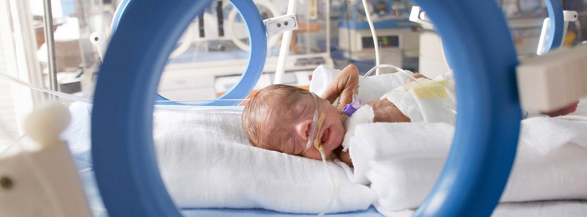 Síndrome de Patau: niña en incubadora