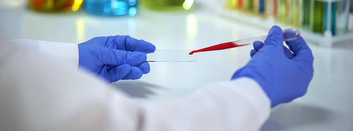 CHCM: investigador goteando sangre para prueba en laboratorio