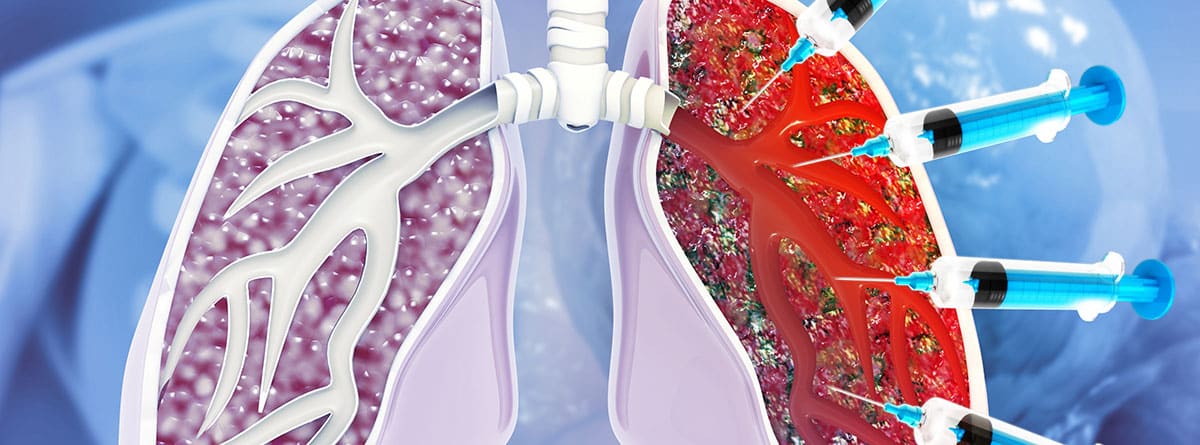 Enfermedad pulmonar EPI: dibujo de pulmones con una infección