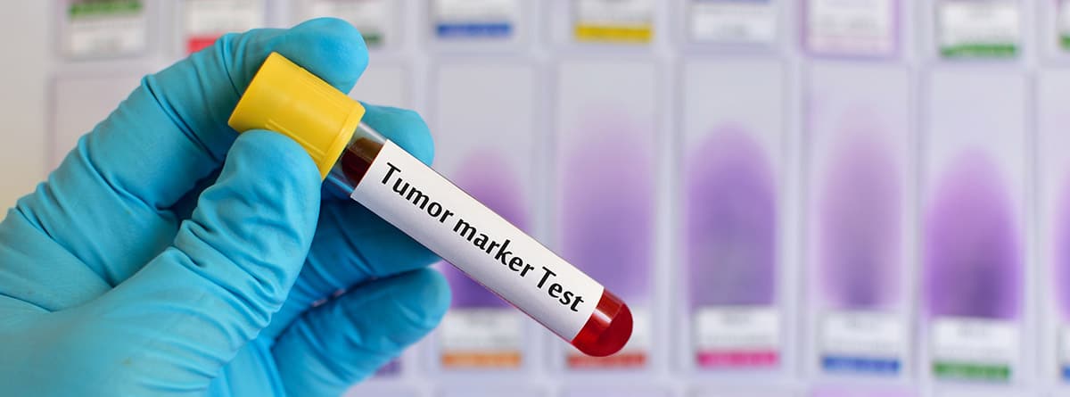 Marcadores tumorales: Muestra de sangre para pruebas de marcadores tumorales