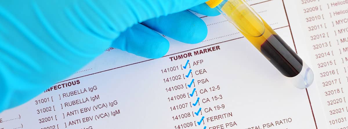 Marcadores tumorales: Muestra de sangre para pruebas de marcadores tumorales