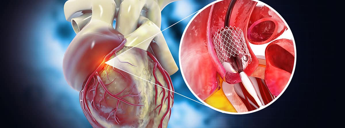 Anuloplastia, cómo y cuándo se realiza: procedimiento de angioplastia alloon con stent en la vena