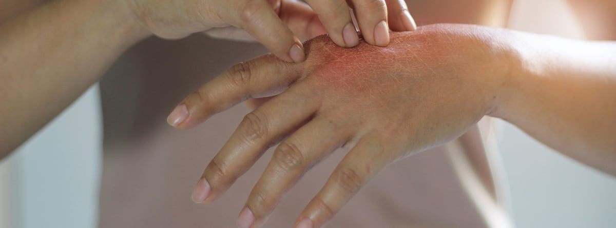 Dermatitis en las manos, ¿cómo curarla? : Mujer rascándose la picazón en la mano, causa de picazón por enfermedades de la piel