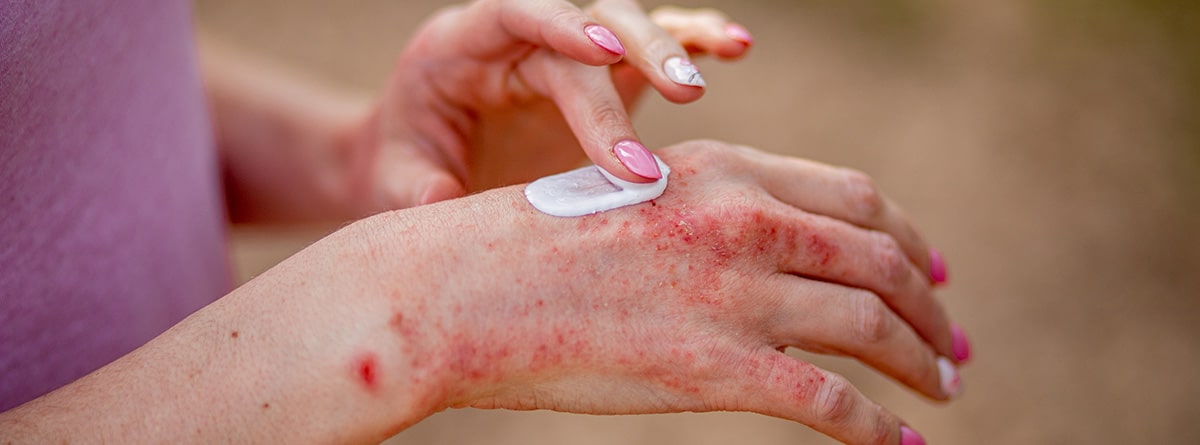 Dermatitis en las manos: Eccema en las manos. La mujer que aplica la pomada, cremas en el tratamiento del eccema, la psoriasis y otras enfermedades de la piel.