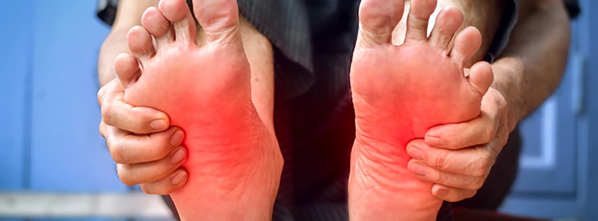 Eritromelalgia: planta de los pies enrojecida con sensación de calor