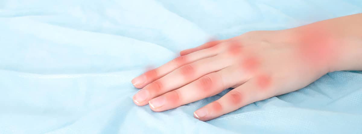 Eritromelalgia: La mano de una mujer sobre una mesa azul con enrojecimiento en las articulaciones de la mano y los dedos