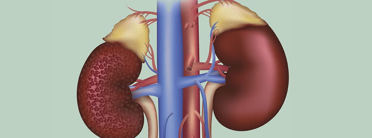 Nefropatía diabética, síntomas y diagnóstico: imágen de riñón con nefropatía diabética