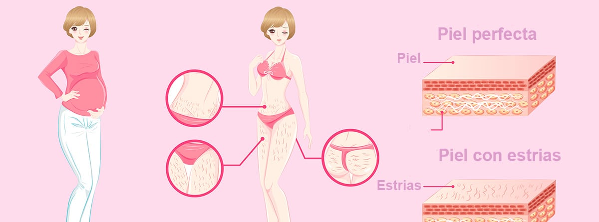 Remedios para las estrias: dibujo de mujer con estrias sobre fondo rosa