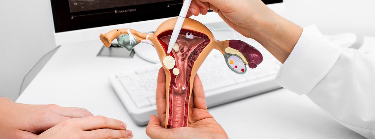 Doctora enseñando a mujer una estructura de utero con polipos