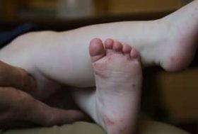 niño con los pies cruzados y ampollas