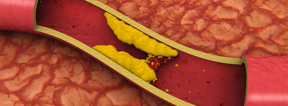 arteria obstruida por colesterol