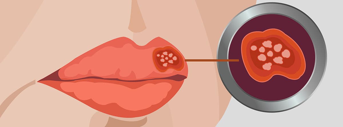 Herpes labial: dibujo de una boca con un herpes labial y un círculo con el dibujo del virus