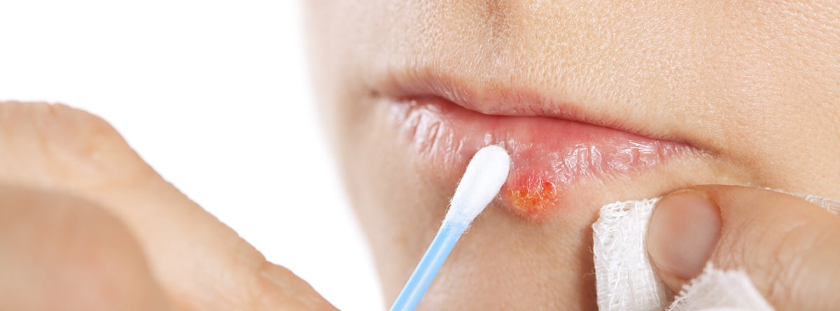 Herpes labial ¿es contagioso: mujer con un herpes en el labio, aplicándose un medicamento con un bastoncillo