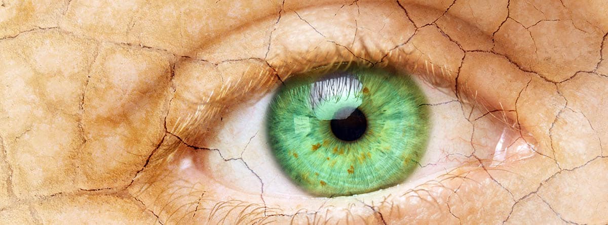 Síndrome del ojo seco, Causas y tratamiento: Primer plano de un ojo femenino con piel agrietada